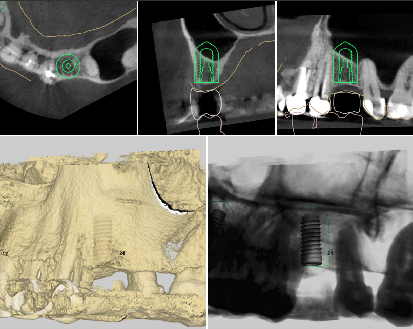 dental implant surgery vancouver bc