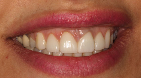 An image of a person smiling after receiving cosmetic dental treatment at Vancouver Dental Specialty Clinic - the top destination for Smile Makeovers in Vancouver.