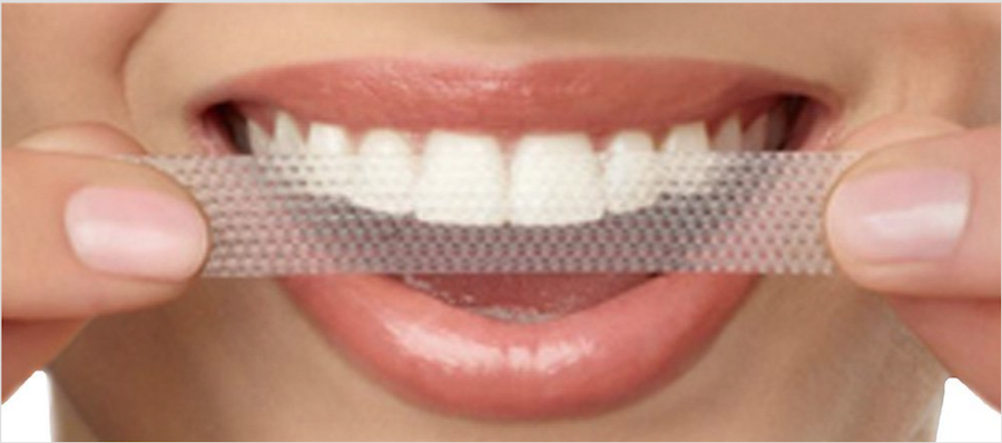 Teeth-Whitening-Options-Vancouver