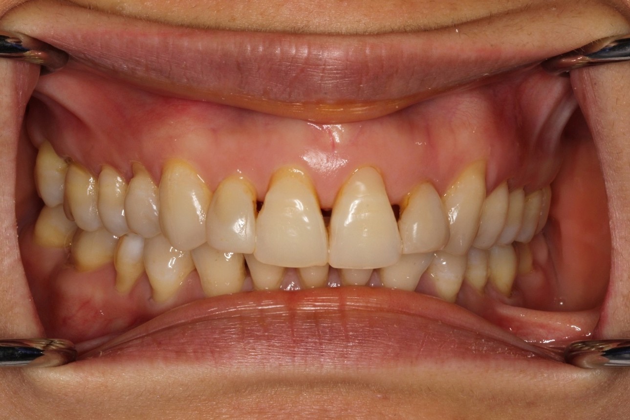 Porcelain Veneers Vancouver BC