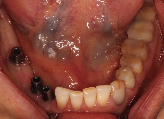 dental implants vancouver bc