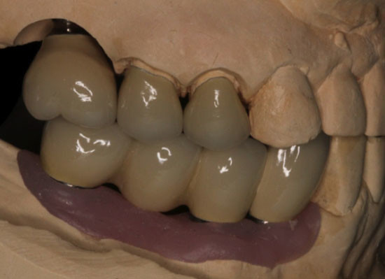 Dental Implants Vancouver BC
