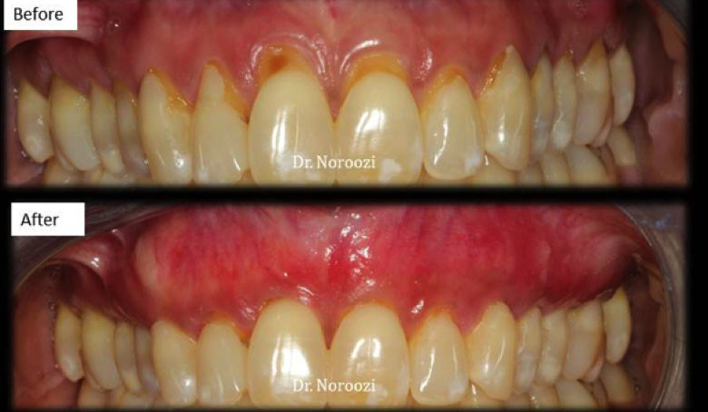 Pinhole Surgical Technique