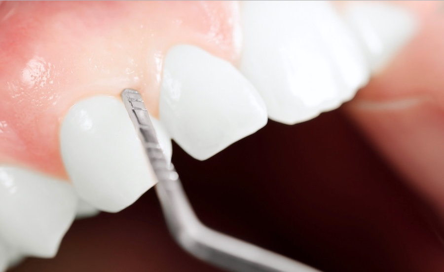 Gum Recession Alternatives - Benefits of Pinhole Surgical Technique Vancouver