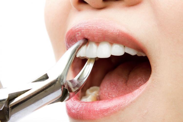 How to Prevent Tooth Extraction - Dental Procedures to Save Teeth