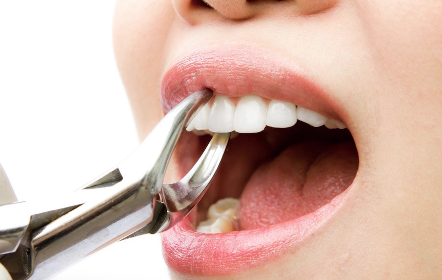 How to Prevent Tooth Extraction - Dental Procedures to Save Teeth