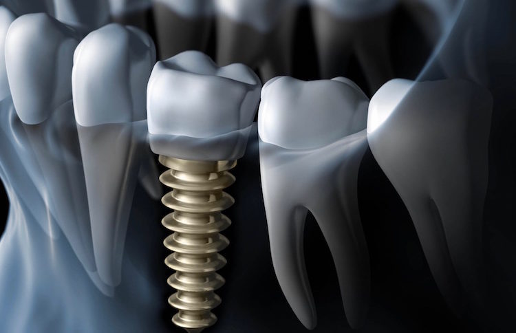 Causes-of-Dental-Implant-Failure