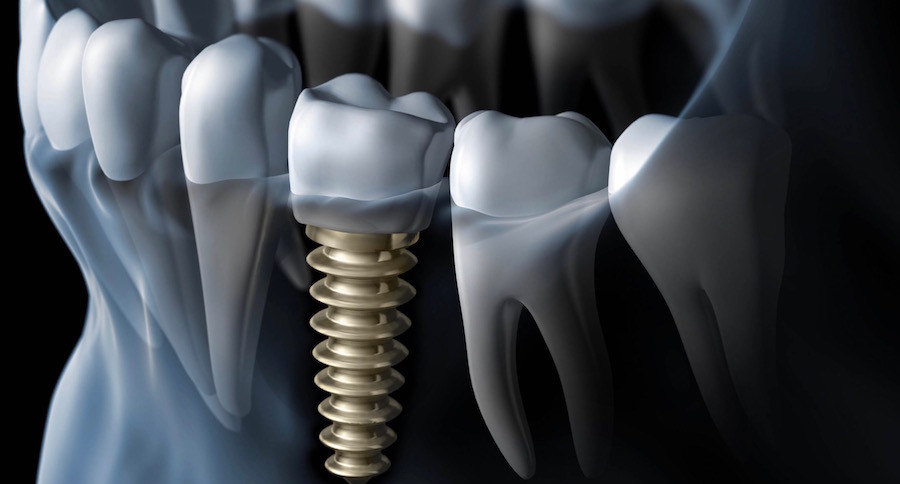 Causes-of-Dental-Implant-Failure