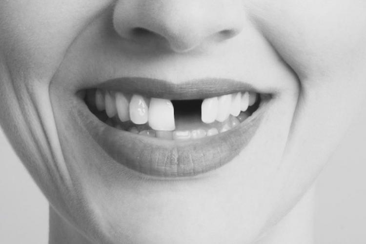 Front Tooth Implant and How to Replace Missing Teeth