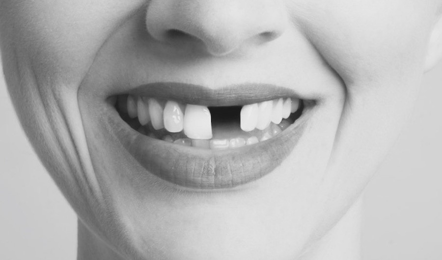 Front Tooth Implant and How to Replace Missing Teeth