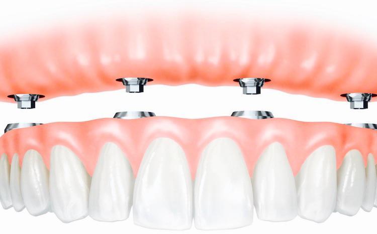 Fixed Denture Implants - Vancouver