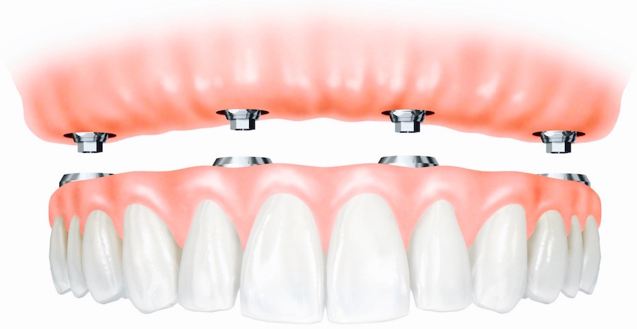 Fixed Denture Implants - Vancouver