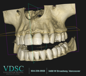 dental implants Vancouver