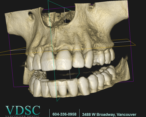 dental implants Vancouver