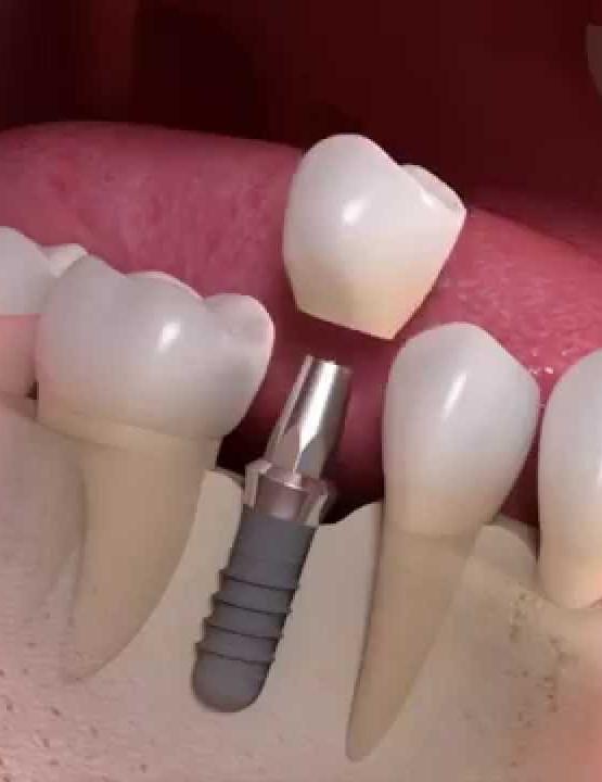 Straumann -Dental implant-Vancouver