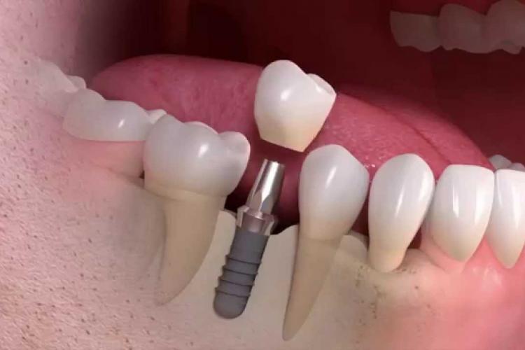 Straumann -Dental implant-Vancouver