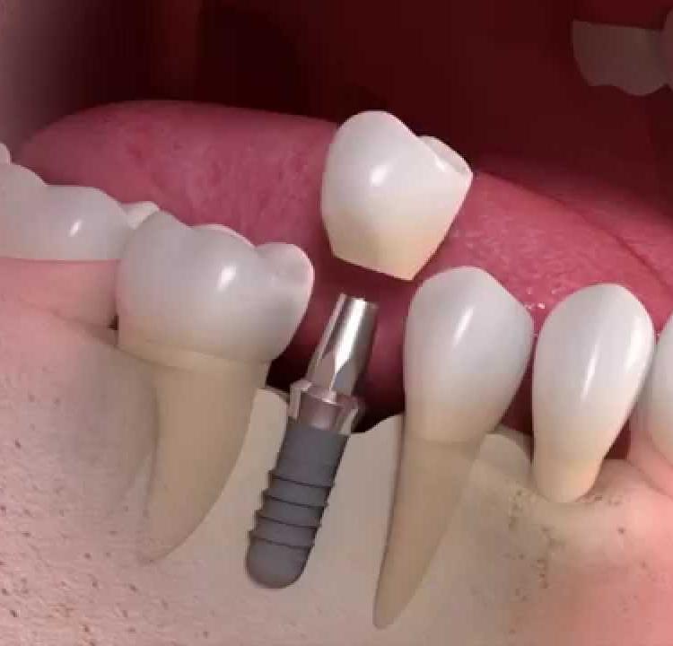 Straumann -Dental implant-Vancouver