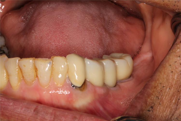 dental implant Vancouver