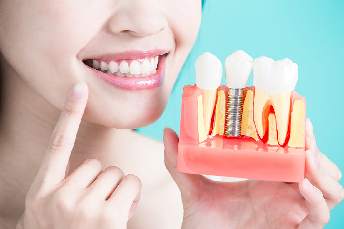 Dental Implant Vancouver