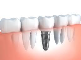 Strauamnn implant-Vancouver