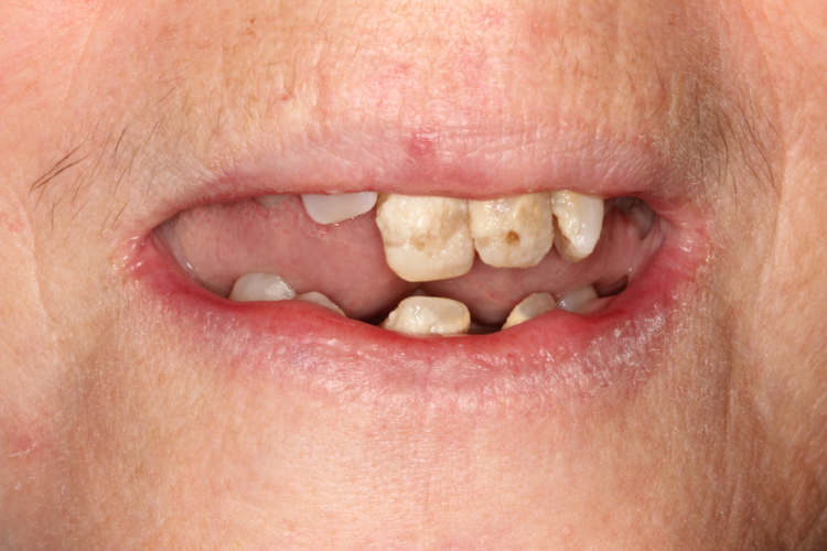 immediate-denture-Vancouver