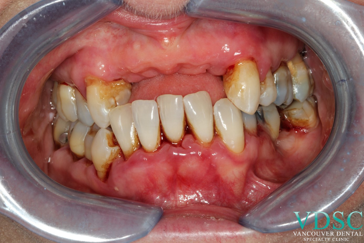 immediate denture-before