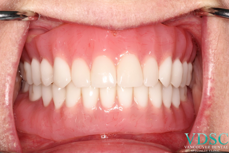 immediate denture after