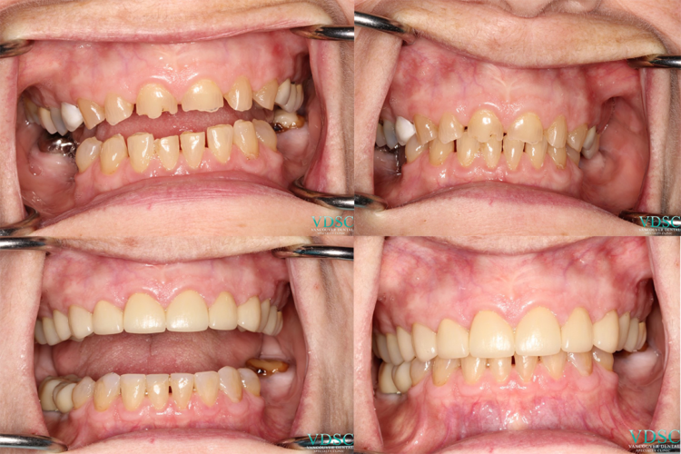 full mouth reconstruction- Vancouver