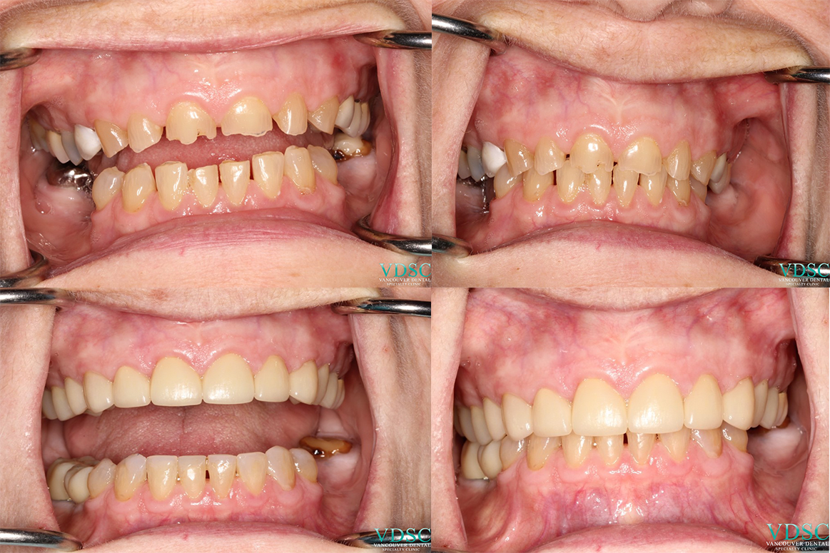 full mouth reconstruction- Vancouver