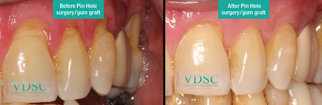 Pin-Hole-surgery-Vancouver Pin-Hole-surgery-Vancouver