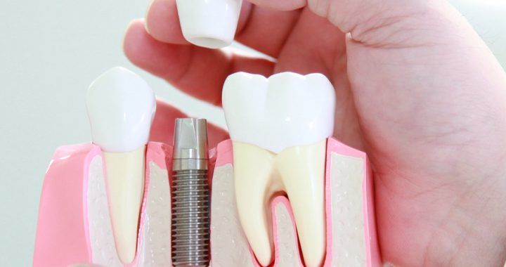 Prosthodontics Vancouver