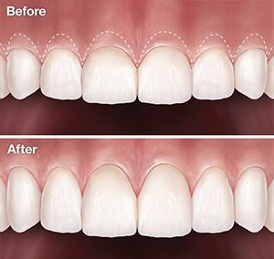 gummy smile treatment