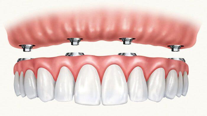 All-On-Four Dental Implants- Vancouver
