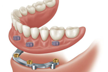 dental implant over denture vancouver