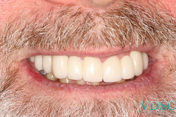 Hypodontia or Genetically Missing teeth