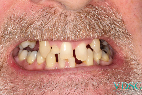 Hypodontia or Genetically Missing teeth