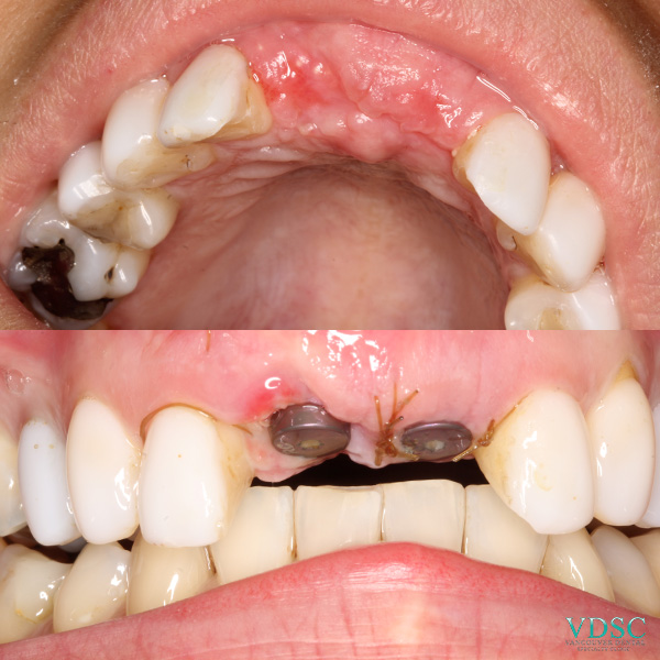 Before and after comparison of front teeth implants for a smile make over at Vancouver Dental Specialty Clinic