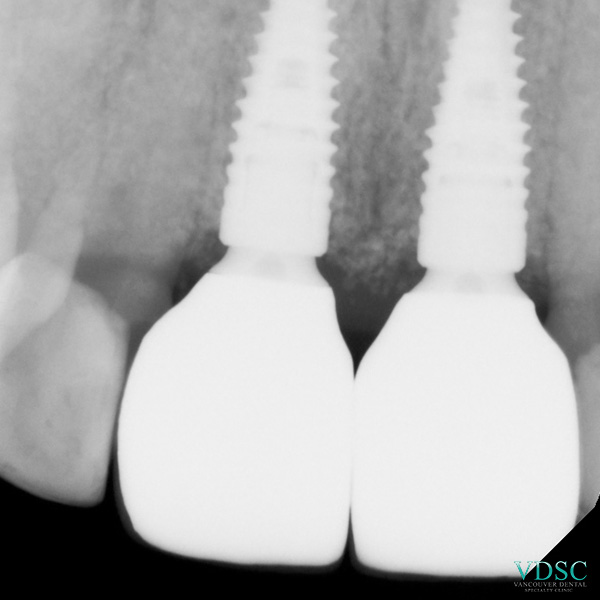 front teeth dental implants X-ray