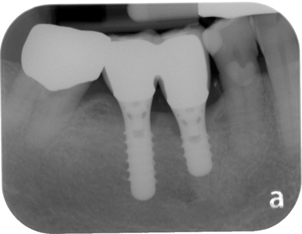 vdsc_blog_dental_implants_type_01