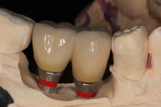 vdsc_blog_dental_implants_type_02