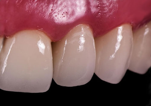 dental crown after