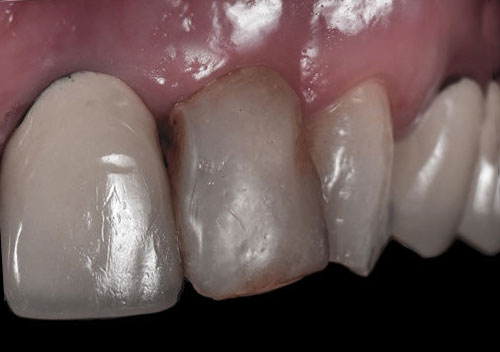 dental crown before