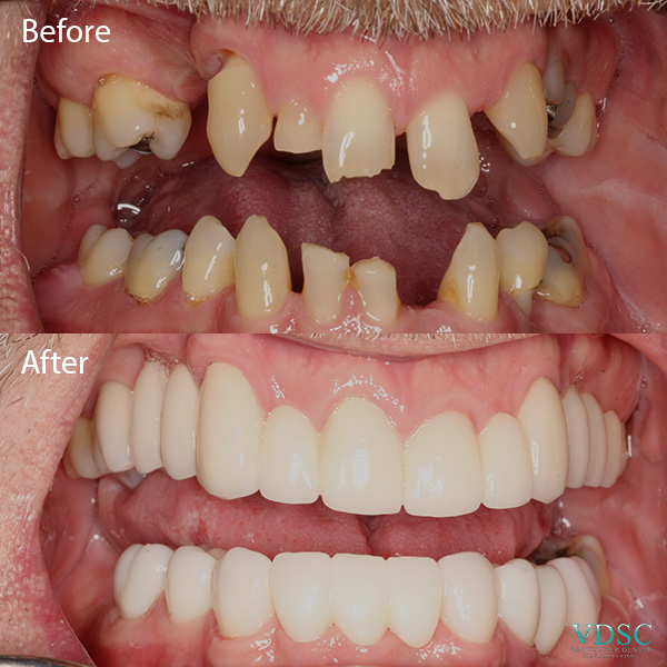 vdsc_full_mouth_reconstruction_ba_2