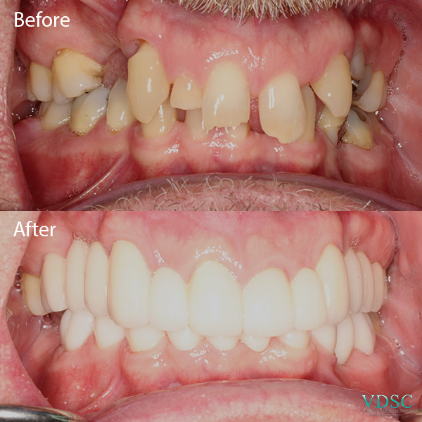 vdsc_full_mouth_reconstruction_ba_3