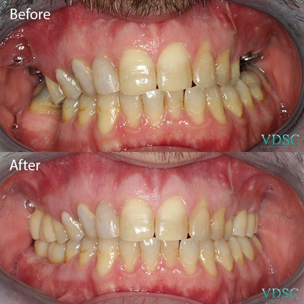 Before and after comparison of back teeth implants at Vancouver Dental Specialty Clinic.