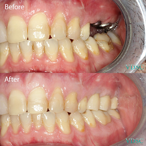 Side-by-side comparison of a patient's back teeth before and after receiving implants at Vancouver Dental Specialty Clinic.