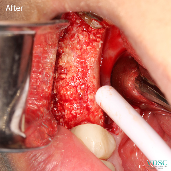 Before and after comparison of bone graft treatment for a resorbed jaw bone at Vancouver Dental Specialty Clinic.