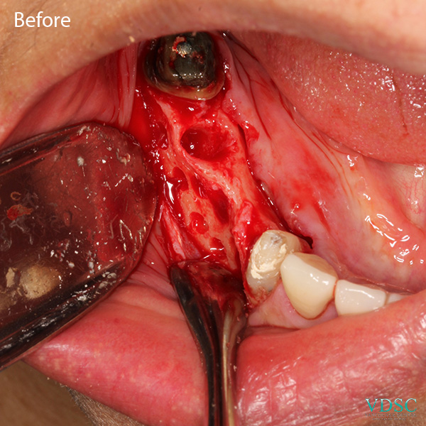 Before and after comparison of a bone graft for a severely resorbed jaw bone at Vancouver Dental Specialty Clinic.