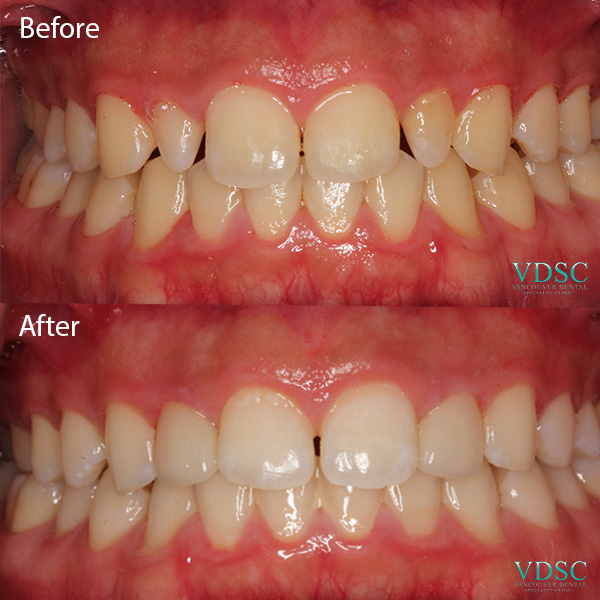 Comparison of teeth before and after a smile make over at Vancouver Dental Specialty Clinic