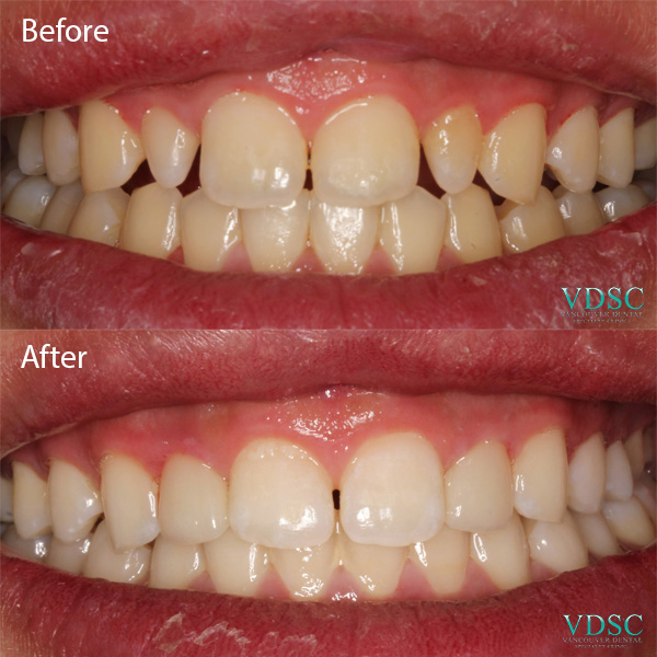Teeth before and after a successful smile make over using ceramic veneers at Vancouver Dental Specialty Clinic.